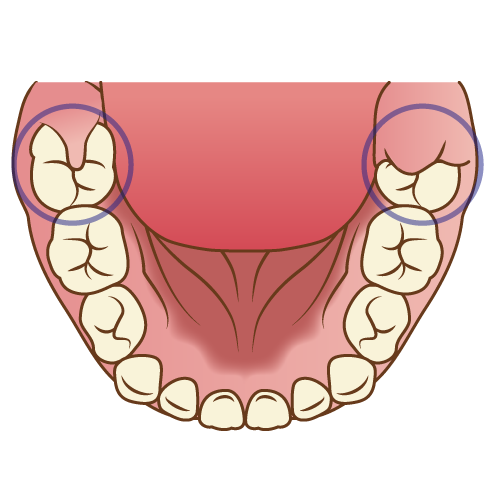 生えかけの六歳臼歯（目印付き）