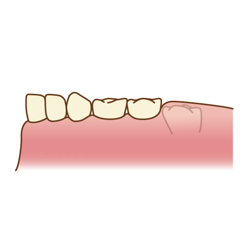 六歳臼歯（まだ埋まってる）