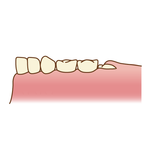 六歳臼歯（ちょっと出てきた）