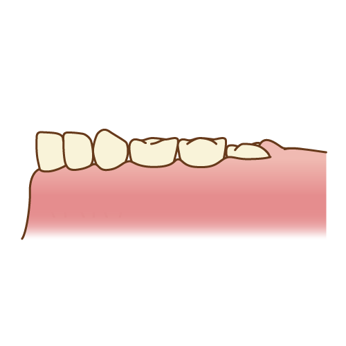 六歳臼歯（半分出てきた）