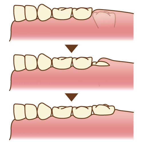 6 歳 臼歯 生え 始め 痛い