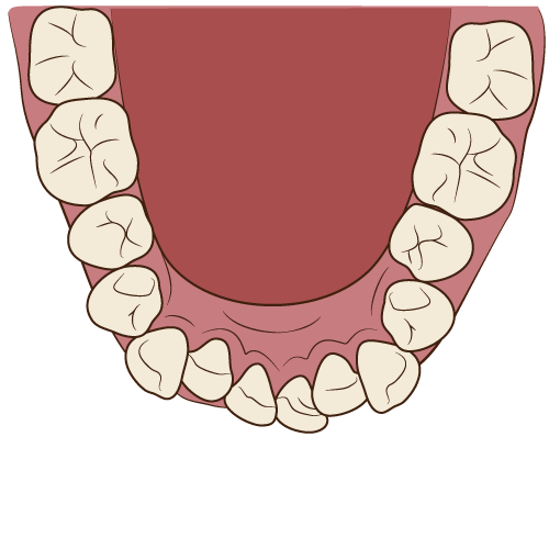 下顎の矯正治療の過程（その1：治療前、ガタガタの歯並び）