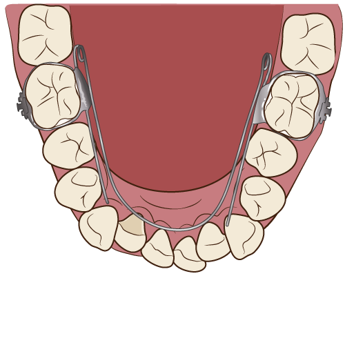 下顎の矯正治療の過程（その2：リンガルアーチを設置）