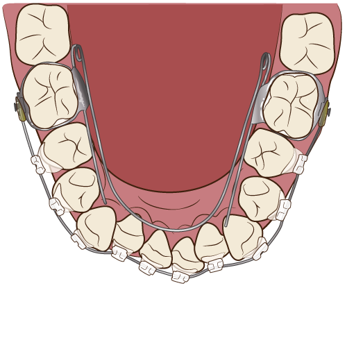 下顎の矯正治療の過程（その3：リンガルアーチ＆ワイヤー）