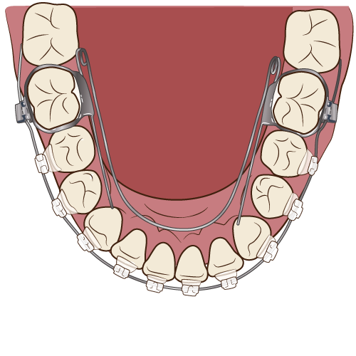 下顎の矯正治療の過程（その4：歯並びが綺麗に整いました♪）