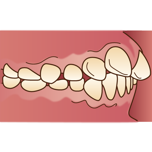 不正咬合（上顎前突・側面）