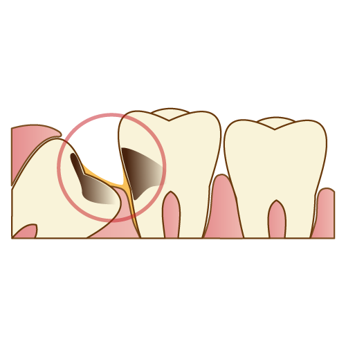 親知らずと歯の間に食べかすがつまる