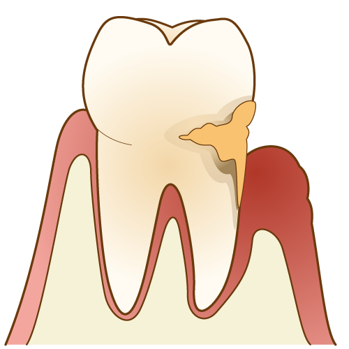歯周病（健康ではない状態）