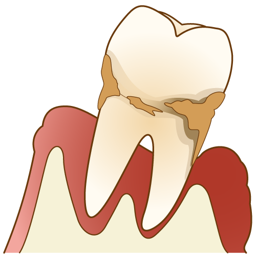 歯周病（不健康な状態）