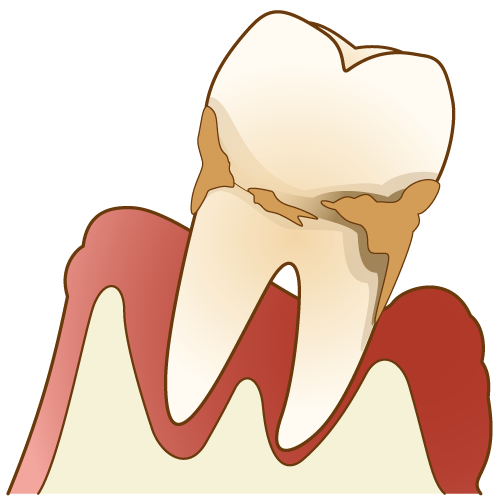 歯周病 イラスト一覧 歯科素材 Com 歯医者さん向け無料イラスト