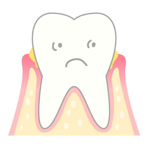 歯周病のメカニズム（歯茎が腫れている）