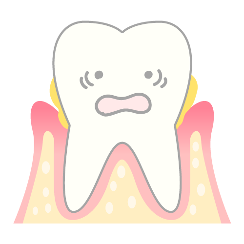 歯周病のメカニズム（骨が溶けている）