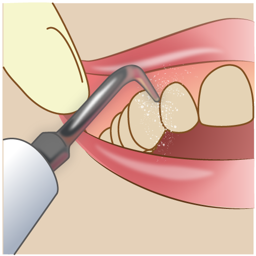 スケーラーで歯石除去