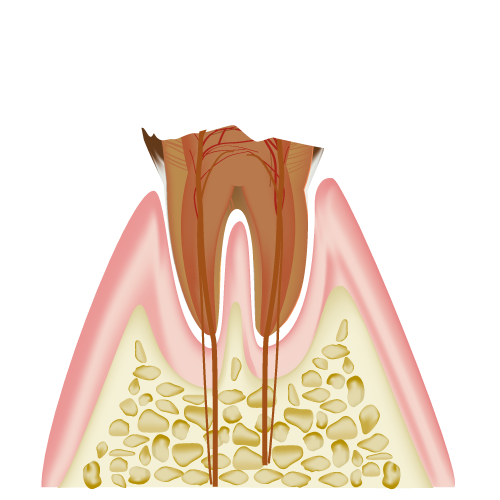 歯の断面（Ｃ４）