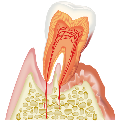 歯の断面（歯周病・傾き）