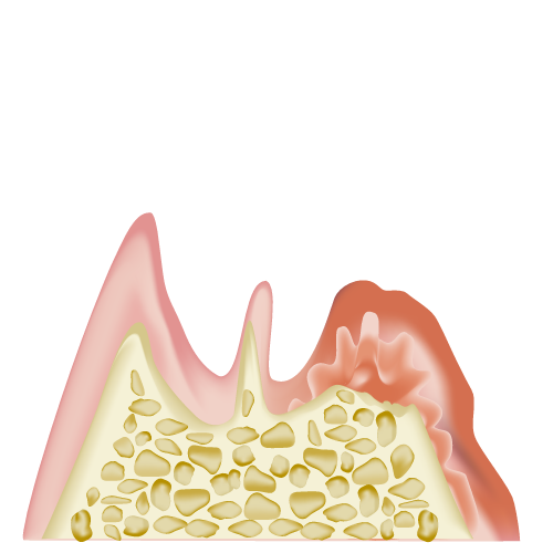 歯の断面（歯周病・失歯）