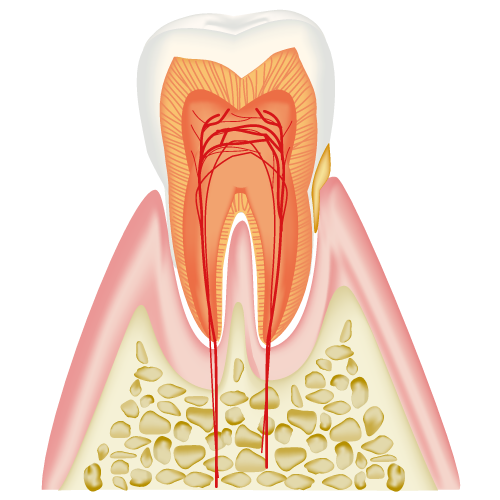 歯の断面（歯垢の付いた歯）