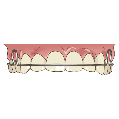 リテーナー装着（正面）