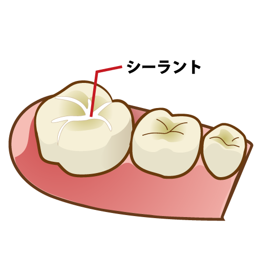 シーラント イラスト一覧 歯科素材 Com 歯医者さん向け無料イラスト