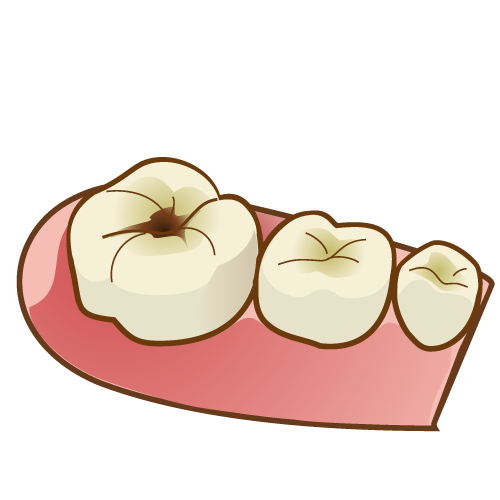 虫歯になった子供の奥歯