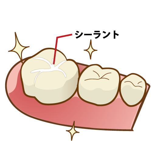 シーラントで溝を埋めた歯 歯科素材 Com 歯医者さん向け無料イラスト