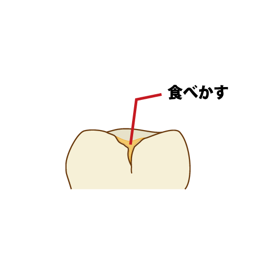 食べかすが詰まってしまった子供の奥歯の断面（キャプション付き）