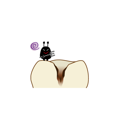 虫歯が住み着いた乳歯の断面