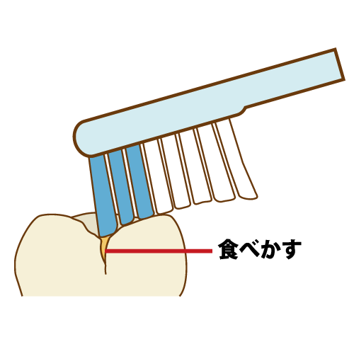 歯ブラシでは届かない溝（キャプション付き）