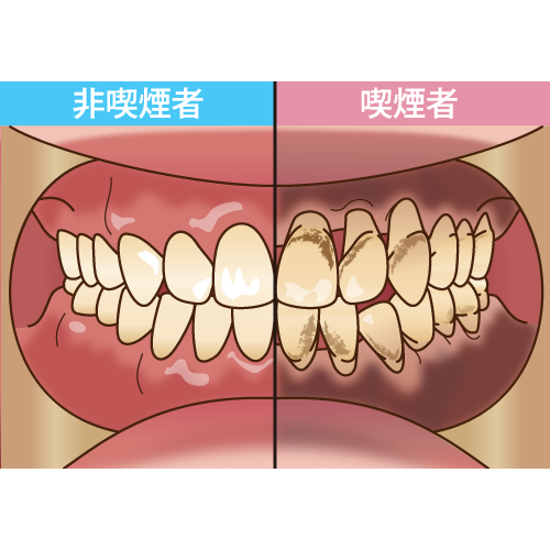 喫煙 イラスト一覧【歯科素材.com】歯医者さん向け無料イラスト