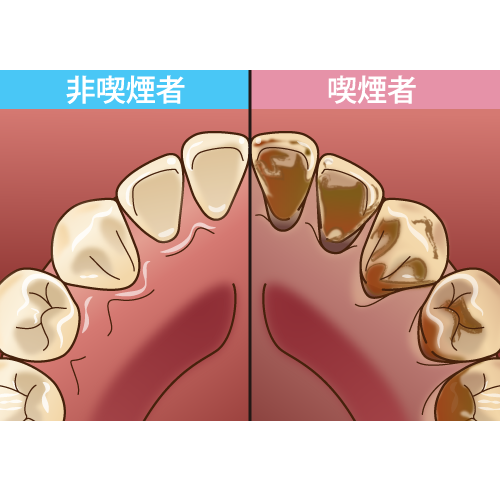 喫煙 イラスト一覧 歯科素材 Com 歯医者さん向け無料イラスト