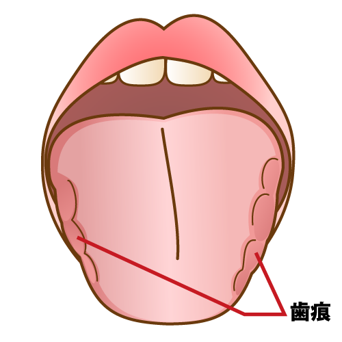 歯痕舌（しこんぜつ）：キャプション有