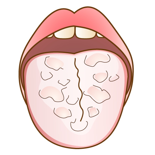 舌苔（ぜったい）：症状の悪化
