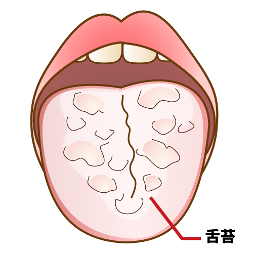 舌苔（ぜったい）：症状の悪化／キャプション有