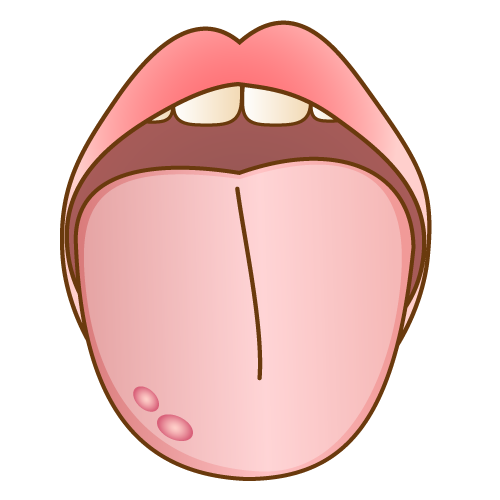舌の口内炎（こうないえん）