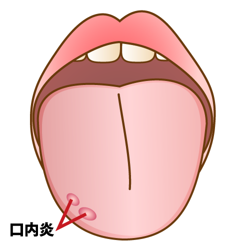 舌の口内炎（こうないえん）：キャプション有