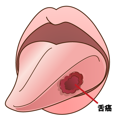 赤い舌癌（ぜつがん）：キャプション有