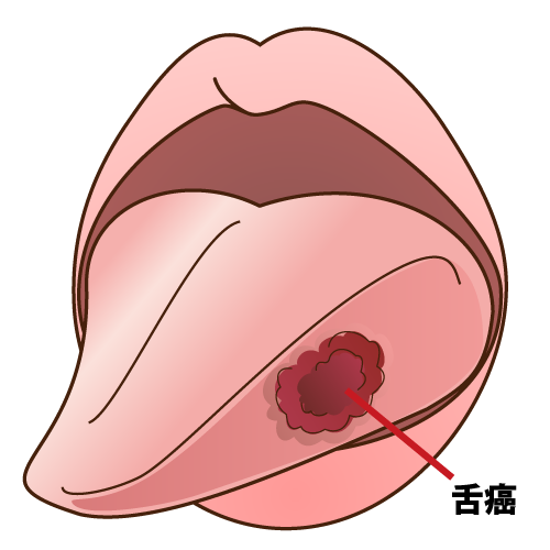 舌のトラブル イラスト一覧 歯科素材 Com 歯医者さん向け無料イラスト