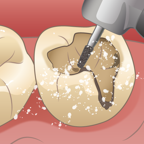 二次カリエス（むし歯の部分を削る）