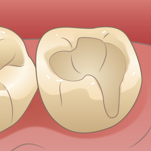 二次カリエス（削った後）