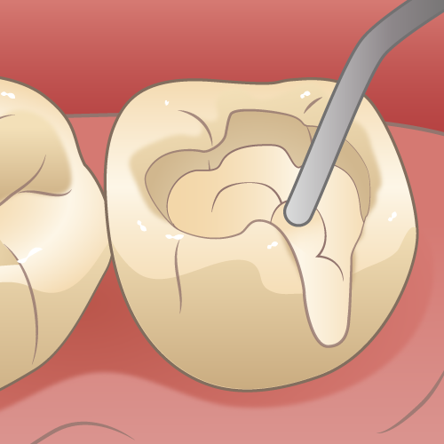 二次カリエス（レジンを充填）