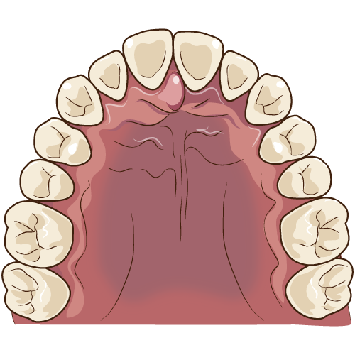 骨隆起：口蓋隆起の比較（なし）