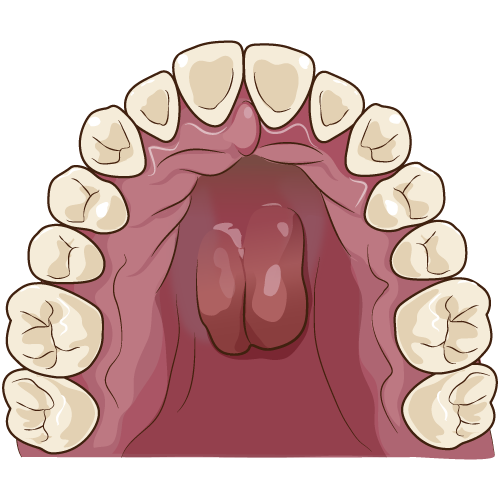 骨隆起：口蓋隆起の比較（重度）