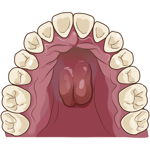 口蓋隆起 イラスト一覧 歯科素材 Com 歯医者さん向け無料イラスト