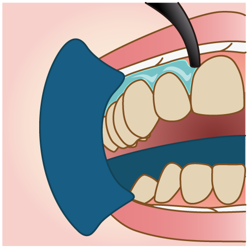 オフィスホワイトニングの手順2/5